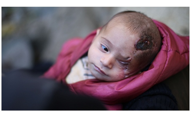 Doğu Guta ablukasından elde kalan simge Kerim bebek Türkiye'de