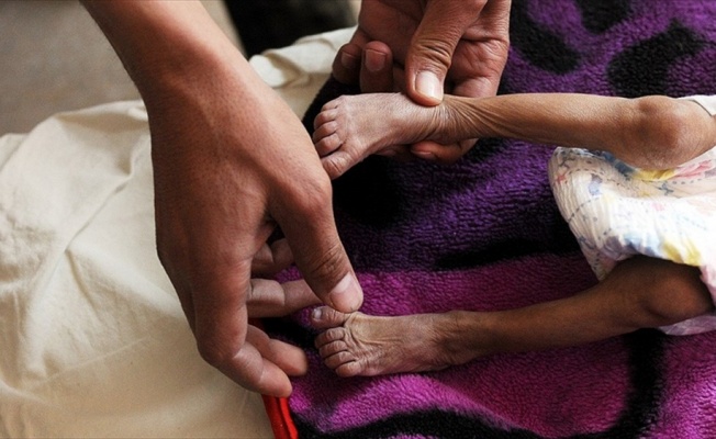 İHH Başkanı Yıldırım: Yemen'de çocuklar bir deri bir kemik kalmış durumda