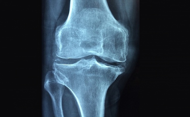 'Osteoporoz 3 kadından birini kıskacına alıyor'