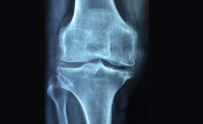 Romatizmal hastalıklar 'osteoporoz' riskini artırıyor