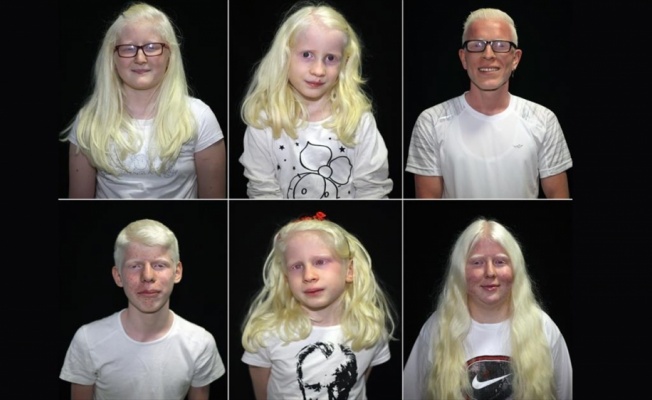 Dünyanın genetik 'beyaz'ları: Albinoslar