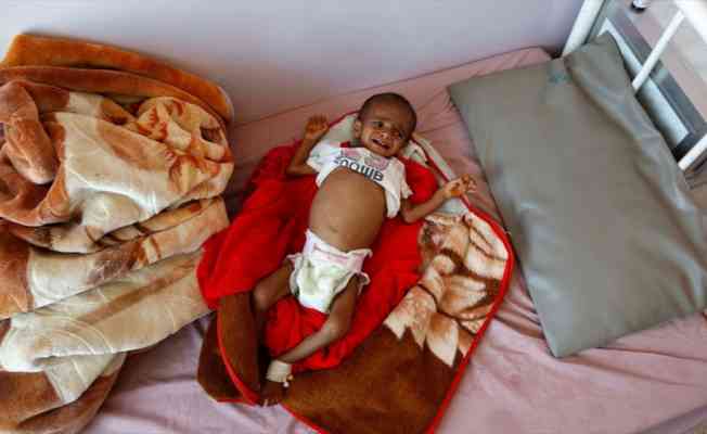 Yemen'de akut yetersiz beslenme sorunu çocukların hayatını karartıyor