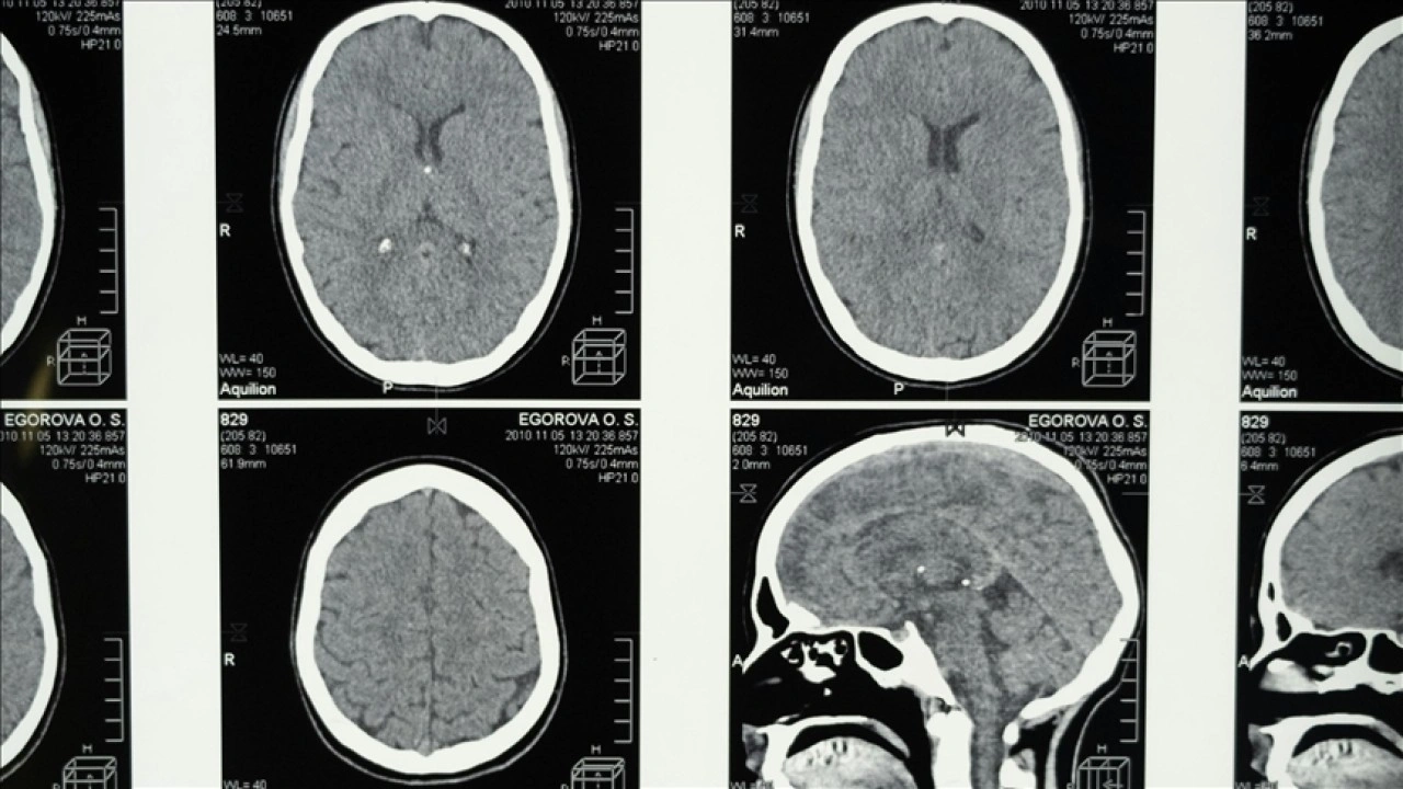 Araştırmalara göre, uykunun REM evresine geçişte zorlanmak Alzheimer belirtisi olabilir