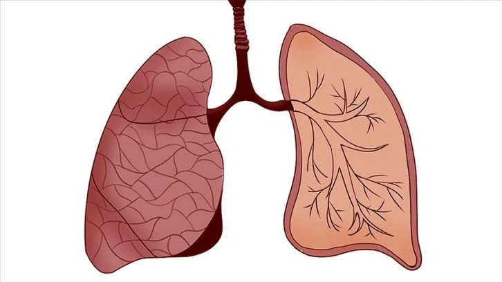 İnsan akciğerinde ilk kez mikroplastiğe rastlandı