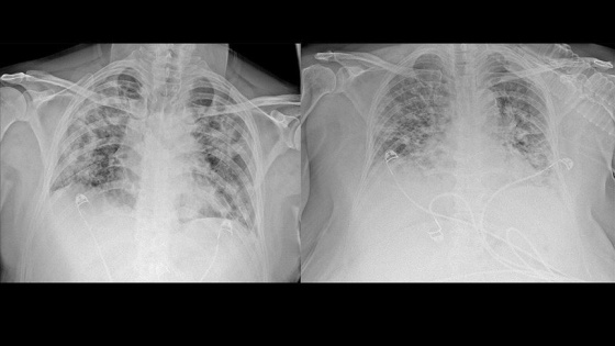 Kovid-19'un akciğerlere verdiği zarar tomografi görüntülerine yansıyor