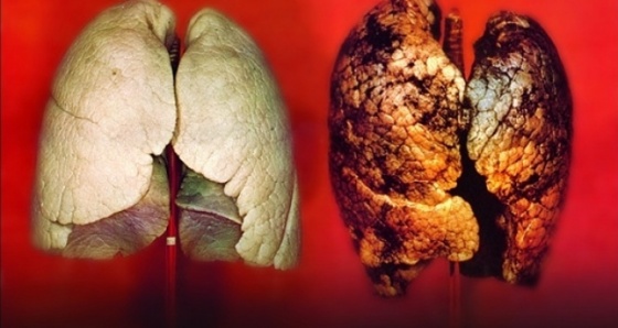 Sinsi gelişen hastalık: Akciğer Kanseri