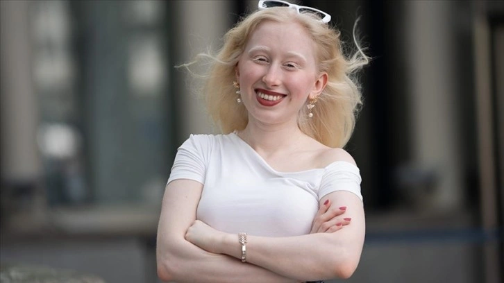 Sosyal medyanın pigmentsiz fenomeni, paylaşımlarıyla albinoların sesi oluyor