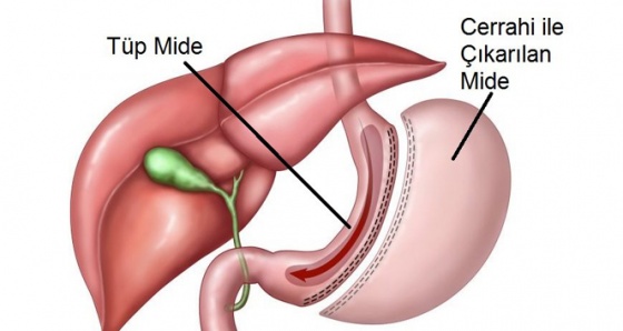 Tüp Mide Ameliyatı (Mide Küçültme) Kimlere Uygulanır?