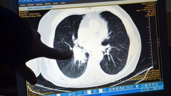 'Türkiye'de erkeklerde en sık akciğer kanseri görülüyor'