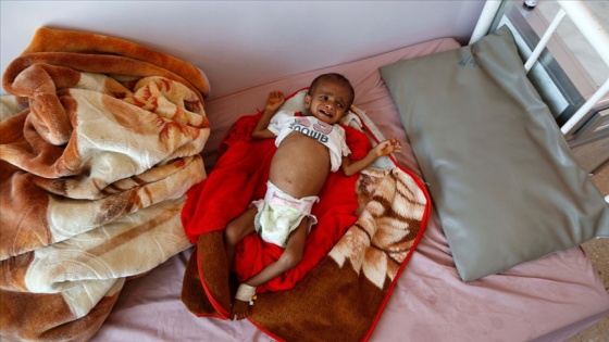 Yemen&#039;de akut yetersiz beslenme sorunu çocukların hayatını karartıyor