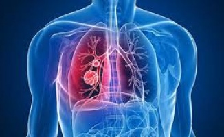 Akciğer kanseri erkeklerde kansere bağlı ölümlerde ilk sırada