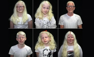 Dünyanın genetik &#039;beyaz&#039;ları: Albinoslar