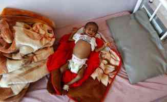 Yemen&#039;de akut yetersiz beslenme sorunu çocukların hayatını karartıyor