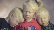 Albinizmli bireyler güneşten koruyucu kremleri için devletten destek bekliyor