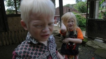BM'ye göre, Kuzey Amerika ve Avrupa'da her 17 bin ila 20 bin kişiden biri albinizm hastası