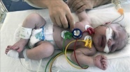 İki günlük Güneş bebeğin damarı stentle açıldı