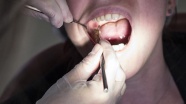 'Sigara diş eti hastalık riskini 4 kat artırıyor'