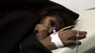 Yemen'deki kolera salgını tarihteki en büyük salgın olarak açıklandı